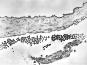 F,39y. | collagen, elastin and oxytalan microfibrils